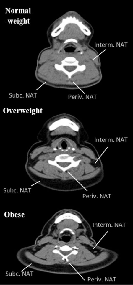 Esta figura muestra la acumulación de grasa en diferentes depósitos del cuello (UGR)