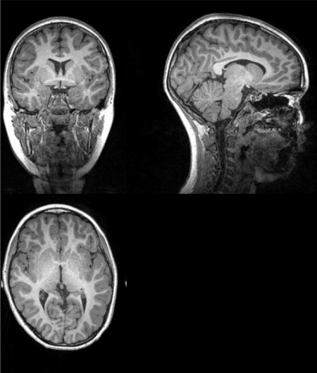 Ejemplo de imagen original de la resonancia magnética a partir de la cual los investigadores extrajeron la cantidad total de materia gris, materia blanca, y cantidad total cerebral (UGR)