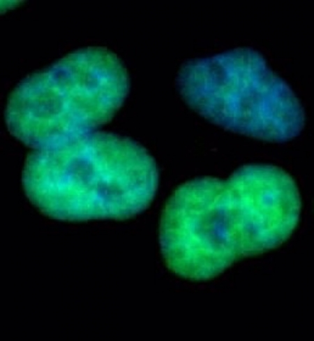 Células humanas de cáncer de pulmón que expresan la proteína EZH2. (UGR)