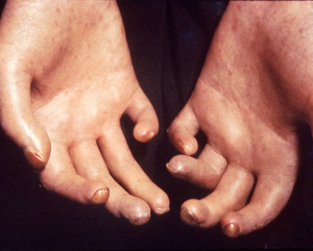 Esclerodermia (DUKE HEALTH/AMERICAN COLLEGE OF RHEUMATOLOGY)