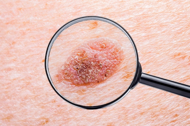 Melanoma maligno (UGR)