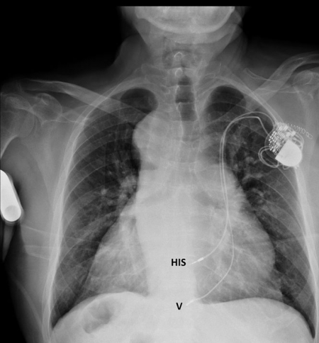 El Hospital Virgen de las Nieves está aplicando una nueva técnica cardiologíca (JUNTA)