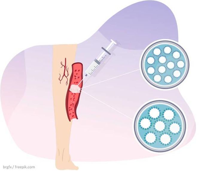 Esquema de una vena varicosa en la que se inyecta espuma esclerosante (UGR)