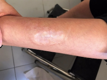 Caso clínico tratado en Granada sobre el `reto de la ballena` (HOSPITAL SAN CECILIO DE GRANADA)