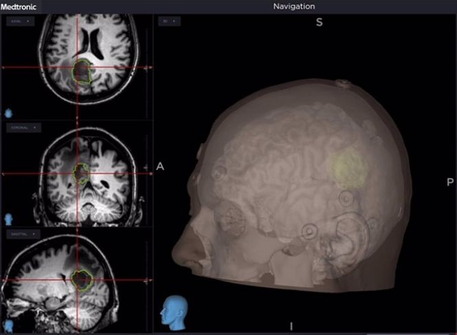 Neuronavegador para intervenciones quirúrgicas vertebrales (VITHAS) 