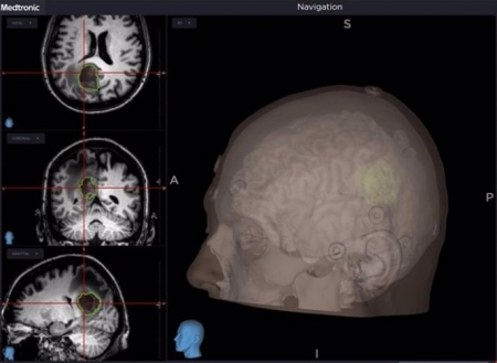 Neuronavegador para intervenciones quirúrgicas vertebrales (VITHAS) 