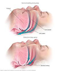 Apnea del sueño (MAYOCLINIC)