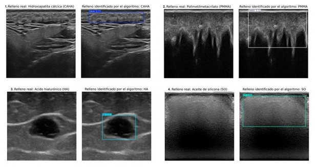 Ecografías que muestran rellenos estéticos identificados por un especialista (izquierda) y las regiones detectadas por el algoritmo (derecha). En los cuatro casos, el algoritmo acertó en clasificar y delimitar el área de cada relleno. (UGR)